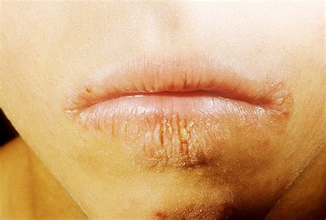 Eczema On Lips Pictures 7 Photos And Images
