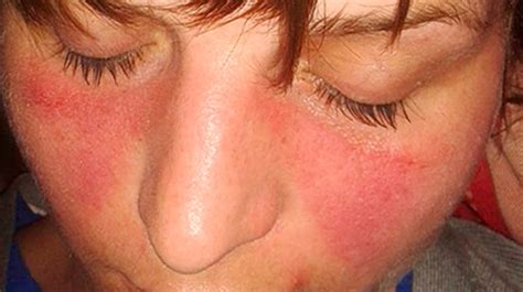 Rash And Swollen Lymph Nodes Causes Photos And Treatment