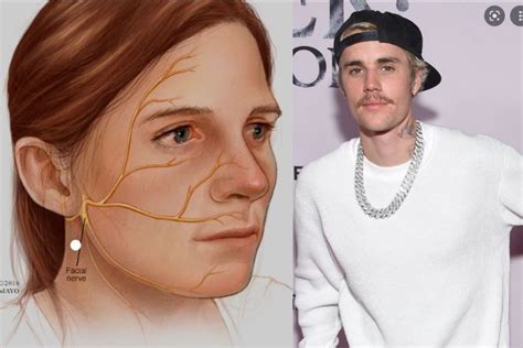 De Qué Se Trata El Síndrome De Ramsay Hunt Que Padece Justin Bieber Periódico Am