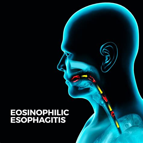 Eosinophilic Esophagitis Gastro Md