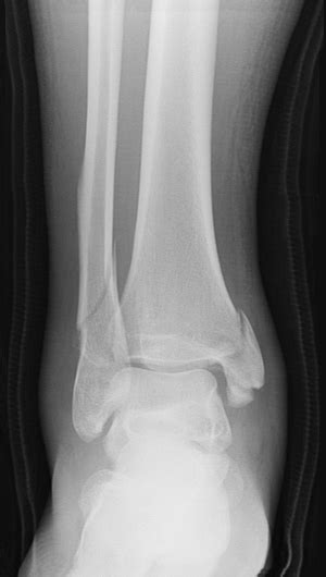 Broken Ankle Types Of Fractures Diagnosis And Treatments Hss