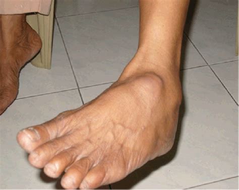 The second region of the body of insects that bears the legs; Swelling on the dorsal surface of left foot. | Download ...