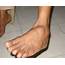 Swelling On The Dorsal Surface Of Left Foot  Download Scientific Diagram