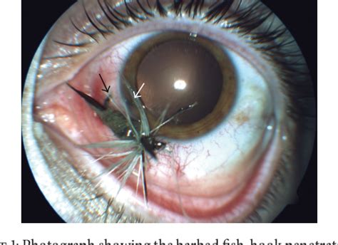 Figure 1 From Penetrating Fish Hook Ocular Injury