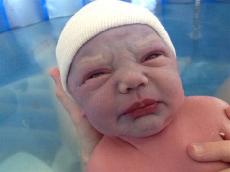 Newborn Bruised Face And Broken Blood Vessels Babycenter