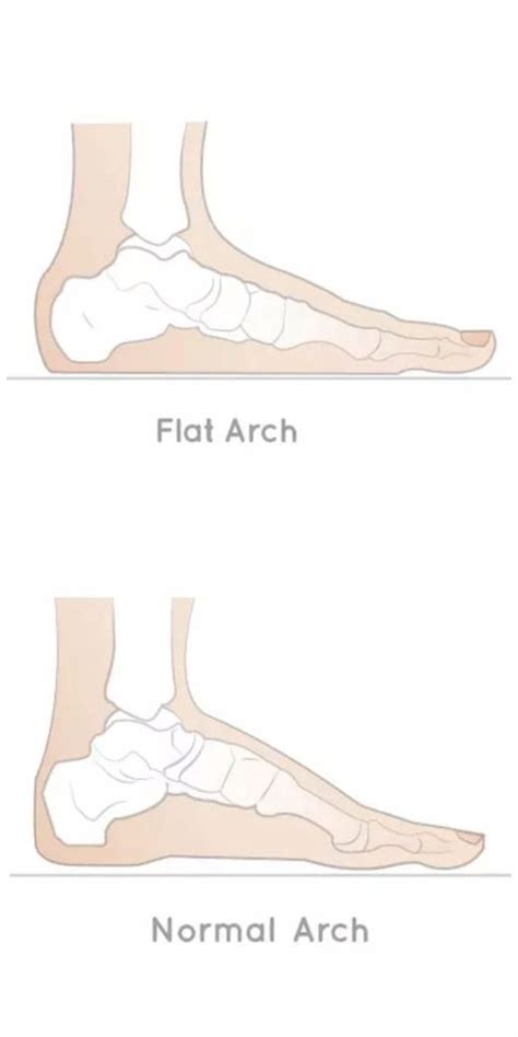 Flat Feet What Is The Best Treatment For Flat Feet Physio2health