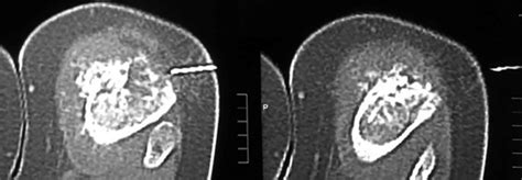 Ultrasound And Ct Guided Biopsy Of Suspicious Musculoskeletal Lesions