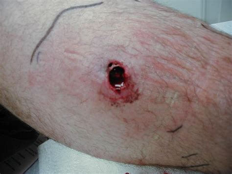 Brown Recluse Spider Bite Stages Pictures Treatment Symptoms