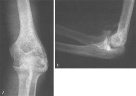Elbow Dislocations Clinical Gate