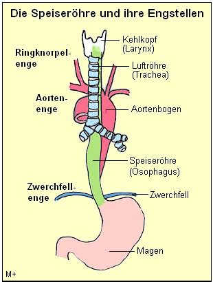 And puncture versus colon ascendens stent peritonitis: web-style