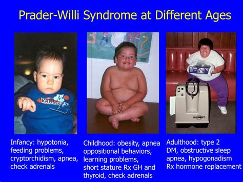 Ppt Update On Medical Issues In Prader Willi Syndrome Powerpoint Presentation Id