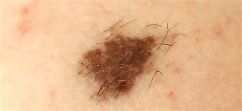 The Different Types Of Moles You Should Know About Skn Clinics