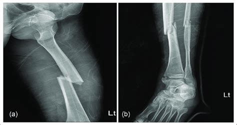 Initial Imaging A X Ray Of The Left Lower Extremity Shows A Closed