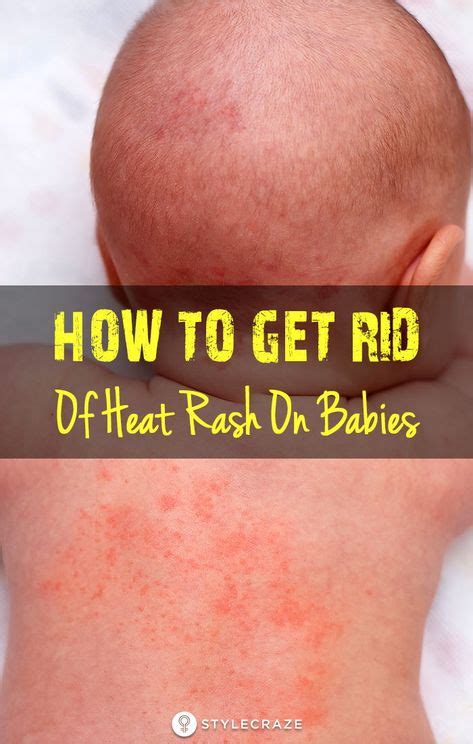 How To Get Rid Of Heat Rash On Babies Heat Rash Baby Heat Rash Heat