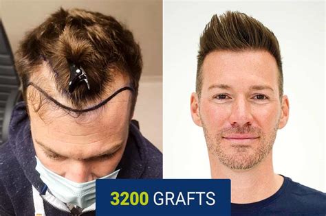 Haartransplantation Vorher Nachher Resultate Der Bio Hair Clinic