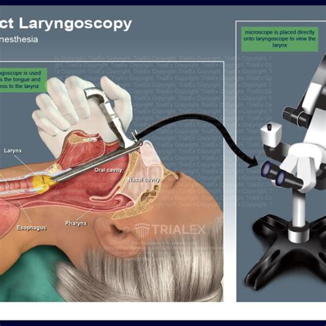 Direct Laryngoscopy Trialexhibits Inc