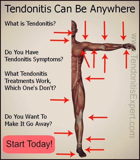 It also helps bend the wrist in the direction of the thumb. Tendonitis, Information on Treatment Symptoms You Won't ...