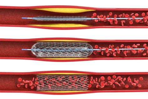 Coronary Artery Stents Show No Benefit In Treating Heart Failure