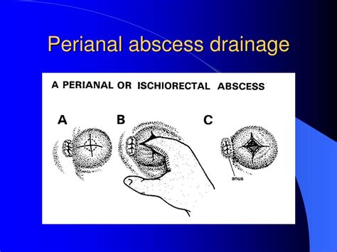 Ischiorectal Abscess Causes Perianal Anal Abscess Causes Symptoms