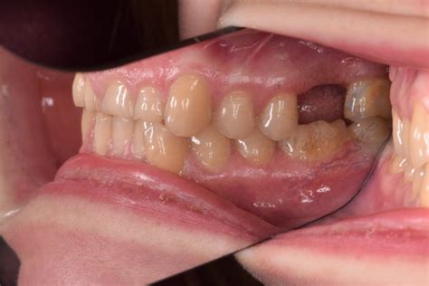 Missing Teeth In Halesowen And Stourbridge Halesowen Dental