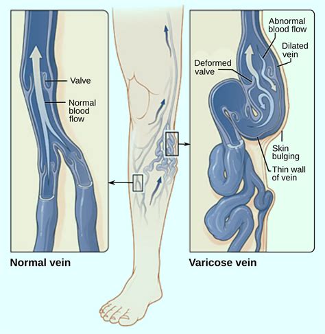 Varicose Veins Linked To Increased Risk Of Deep Venous Thrombosis Sci