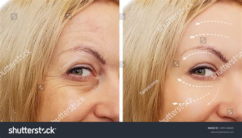 Woman Wrinkles Before After Procedures Stock Photo