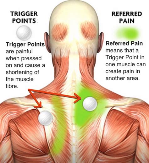 Osvobozeno Prosperovat Kopírovat Muscle Knots In Neck Symptoms Povolení Zavři Výše