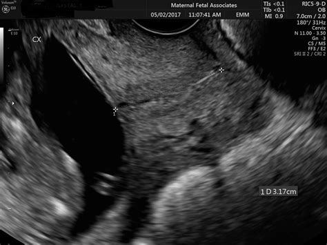 Transvaginal Ultrasound Maternal Fetal Associates Of The Mid Atlantic