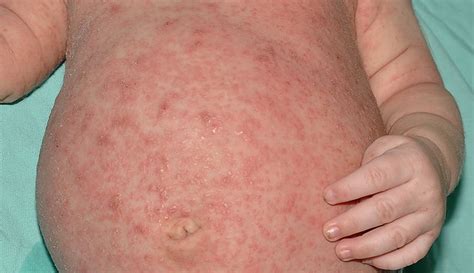 Top 9 How Do I Know If I Have Scabies On My Skin 2022