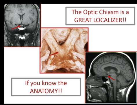 The Optic Chiasm Flashcards Quizlet