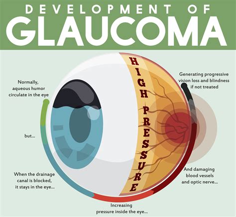 Infographic With Development Of Untreated Glaucoma Disease Discovery