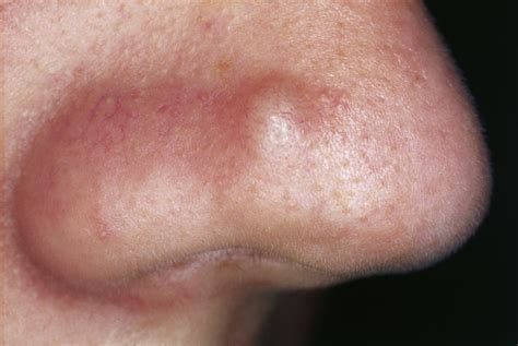 Fibrous Papule Of The Nose Small Skin Colored Papule With Smooth