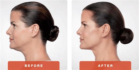 Austin Kybella Injectables Double Chin Treatment By Dr Bittar