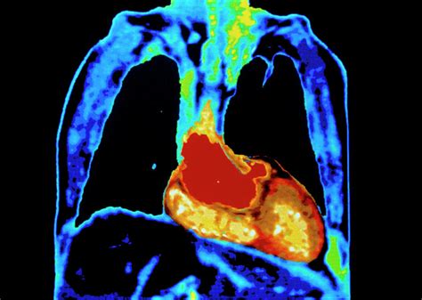 Mri Scan Of Healthy Heart And Lungs Photograph By Gjlpscience Photo