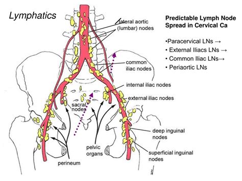 Cervical Cancer Lymph Nodes