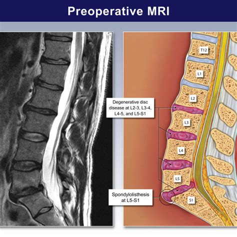 Cervical Mri Trialexhibits Inc 361