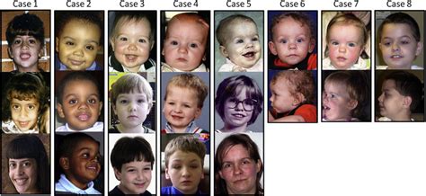 The skin folds at the inner corner of the eyelids are called epicanthal folds and can be broad in some babies. Facial Phenotype of Patients with 17q12 Deletions ...