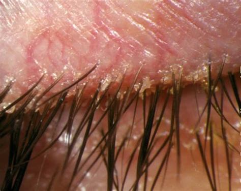 What Causes Blepharitis Swollen Eyelids