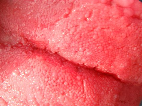 What Your Tongue Reveals About Your Health | Ear, Nose, Throat, and ...