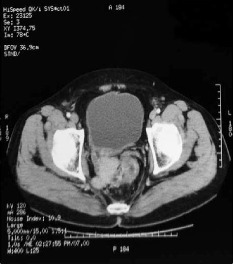 Figure 1 From Management Of A Ruptured Mucinous Mesenteric Cyst With