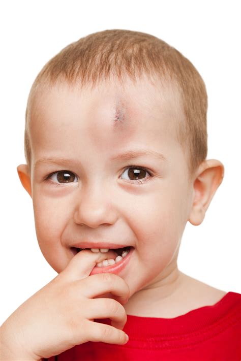 Baby Concussion Symptoms Australia Get More Anythinks