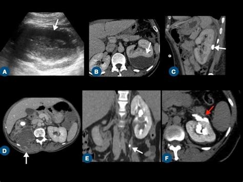 Complicated Pyelonephritis In Three Different Patients Subcapsular