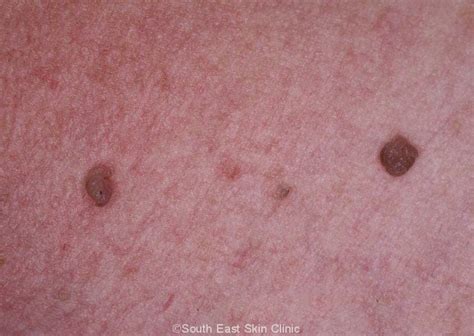 Skin Tags South East Skin Clinic