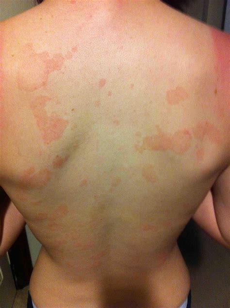 Ive Had These Red Blotches On My Back Awhile Now But No Insurance I