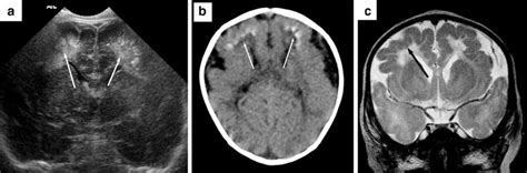 Sodium Channelopathy Scn3a In A 2 Month Old Boy With Apnea And
