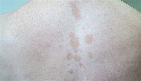 Tinea Versicolor Symptoms Causes And Treatments