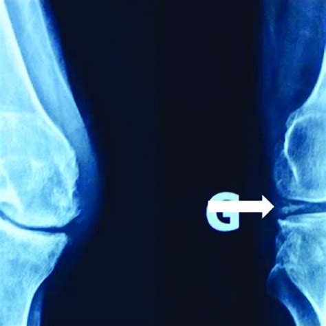 X Rays Of Both Knees Showed Bilateral Osteoarthritis With Download