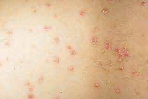 Guttate Psoriasis Images Symptoms And Pictures