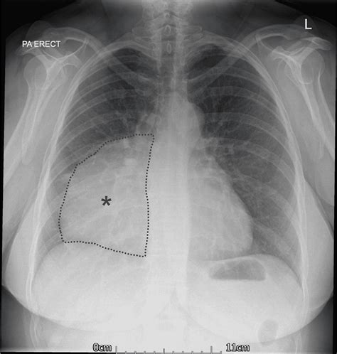 Cureus An Incidental Finding Of A Large Pericardial Cyst