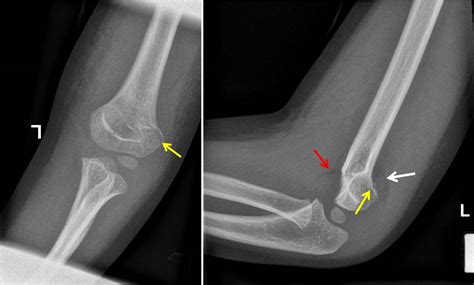 Supracondylar Fracture Radiology Cases